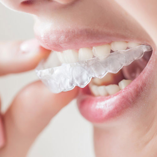 Woman putting her Invisalign aligner in her mouth