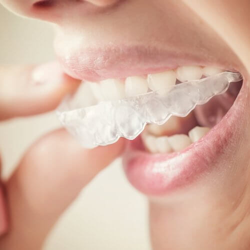 Woman putting in her Invisalign clear aligners
