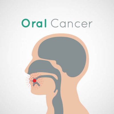 Graphic with a side profile and a target in the mouth indicating oral cancer