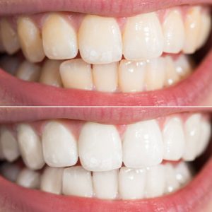 Before and after Zoom! Whitening